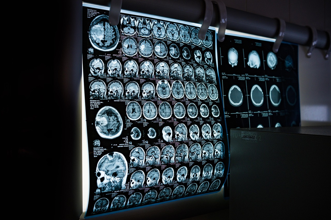 The duration of depression may influence how severely the disease alters the brain